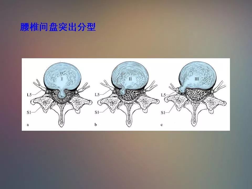 影像PPT - 【PPT】腰椎退行性变腰痛的MR诊断-27