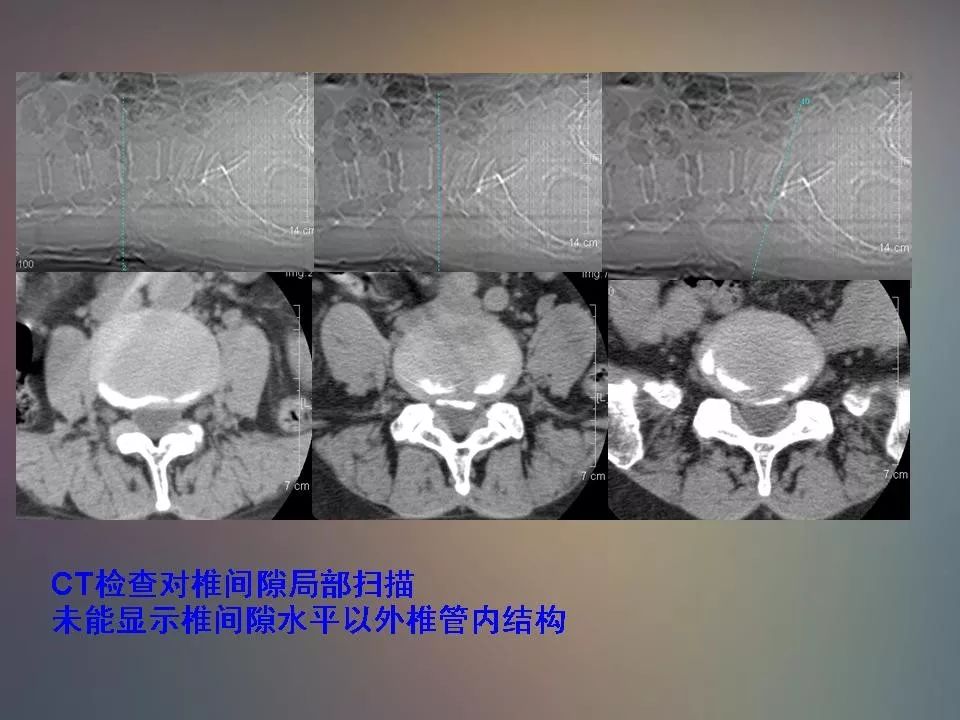 影像PPT - 【PPT】腰椎退行性变腰痛的MR诊断-28