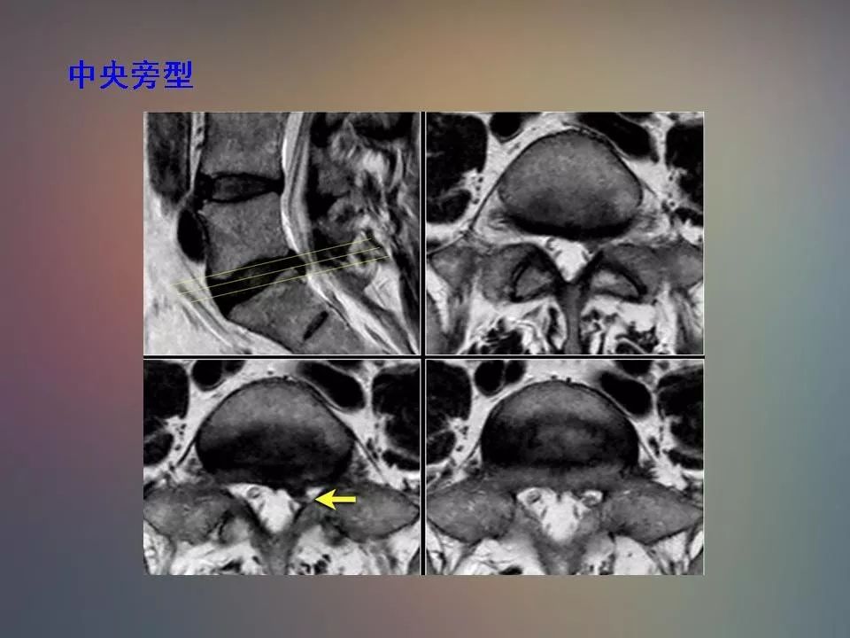 影像PPT - 【PPT】腰椎退行性变腰痛的MR诊断-30
