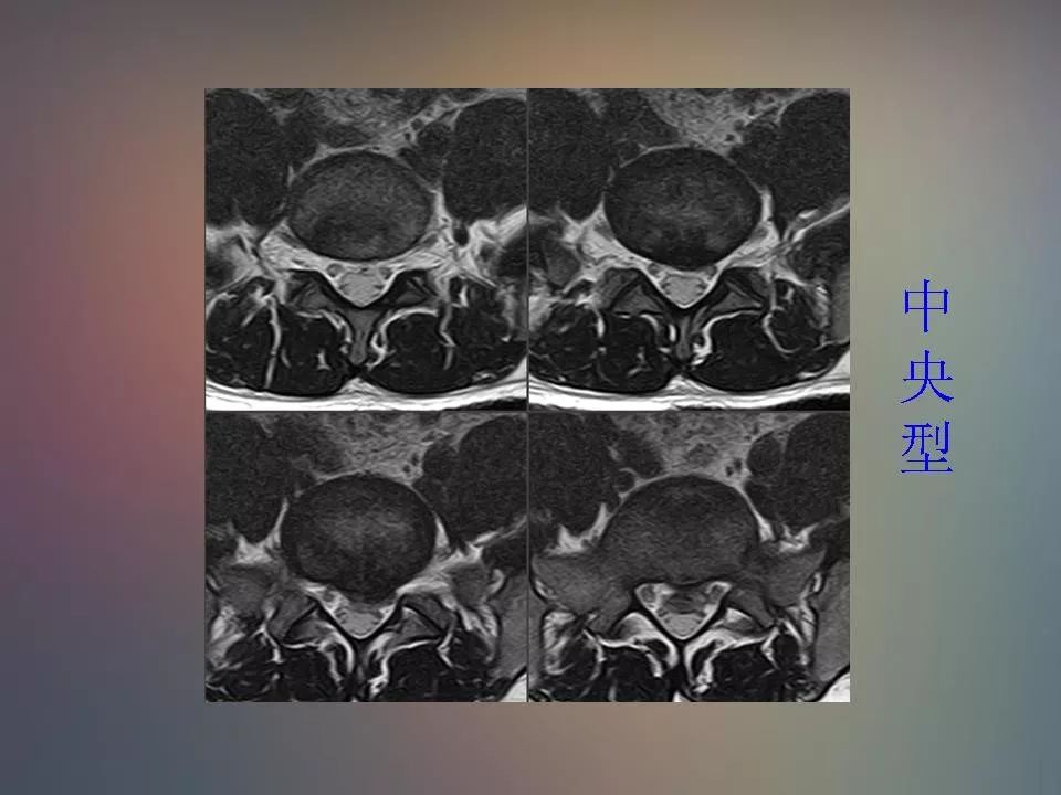 影像PPT - 【PPT】腰椎退行性变腰痛的MR诊断-29