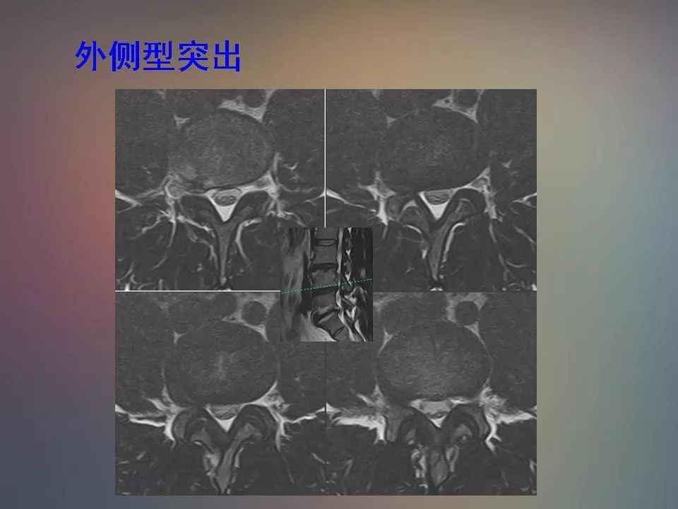 影像PPT - 【PPT】腰椎退行性变腰痛的MR诊断-32