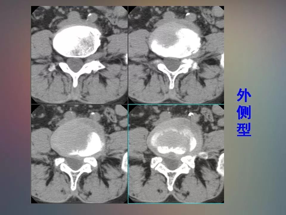 影像PPT - 【PPT】腰椎退行性变腰痛的MR诊断-33