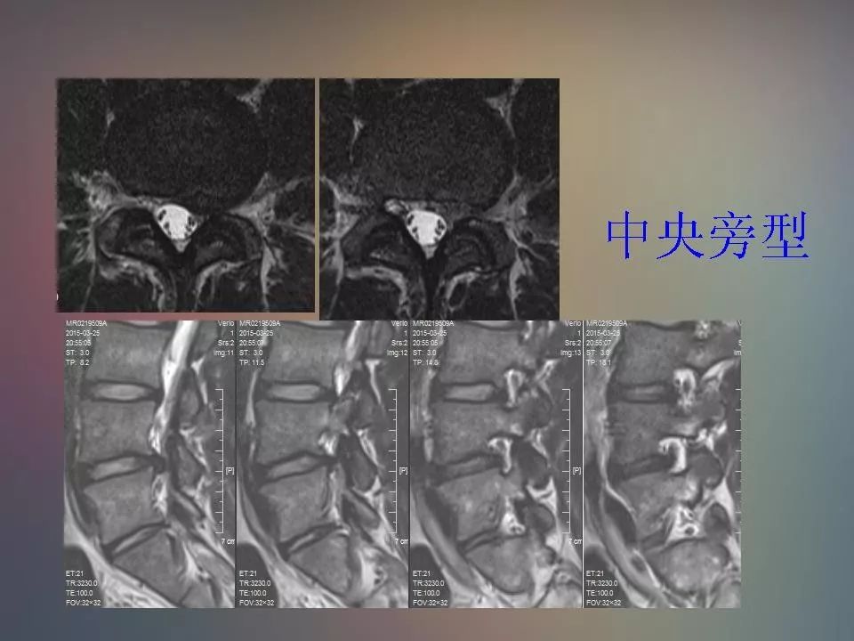 影像PPT - 【PPT】腰椎退行性变腰痛的MR诊断-31