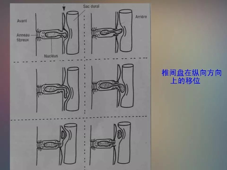 影像PPT - 【PPT】腰椎退行性变腰痛的MR诊断-34