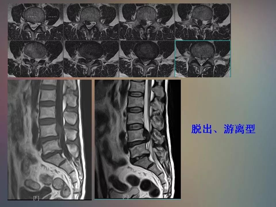 影像PPT - 【PPT】腰椎退行性变腰痛的MR诊断-35