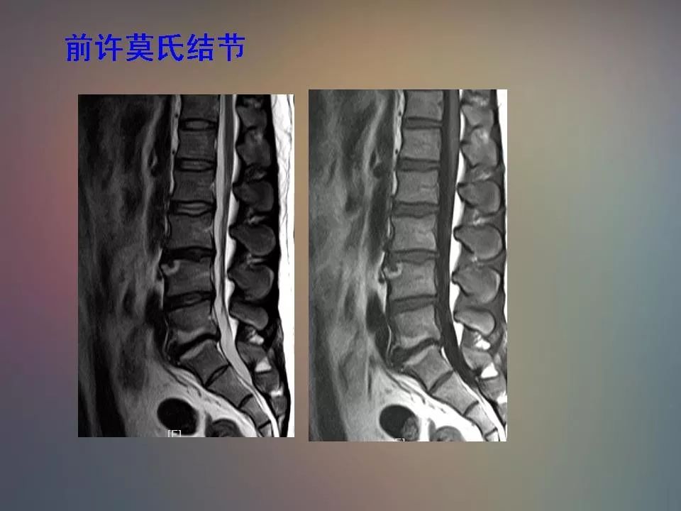 影像PPT - 【PPT】腰椎退行性变腰痛的MR诊断-38