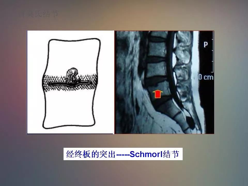 影像PPT - 【PPT】腰椎退行性变腰痛的MR诊断-37