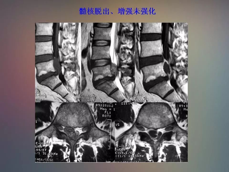 影像PPT - 【PPT】腰椎退行性变腰痛的MR诊断-36
