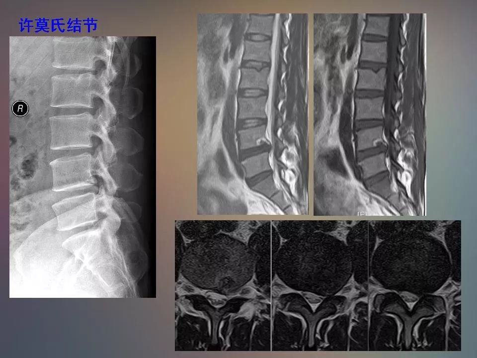 影像PPT - 【PPT】腰椎退行性变腰痛的MR诊断-39