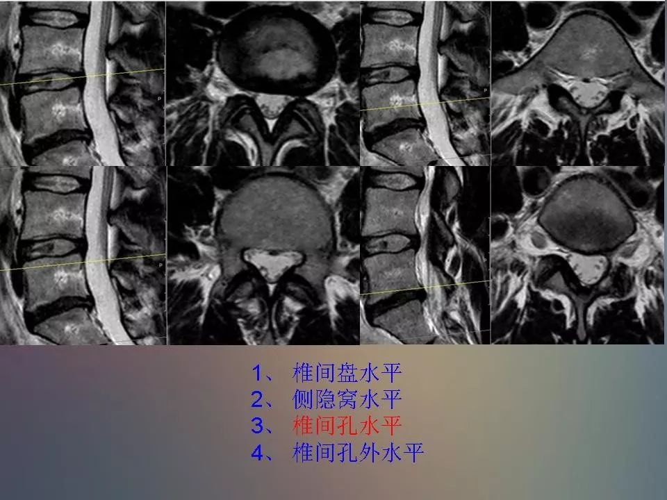 影像PPT - 【PPT】腰椎退行性变腰痛的MR诊断-42