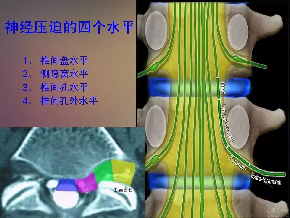 影像PPT - 【PPT】腰椎退行性变腰痛的MR诊断-40