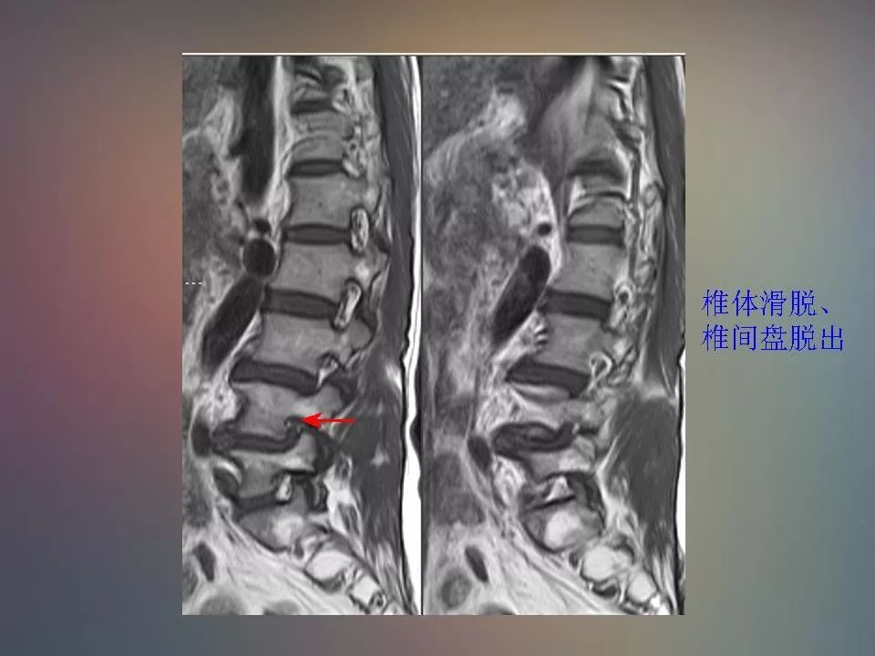 影像PPT - 【PPT】腰椎退行性变腰痛的MR诊断-46