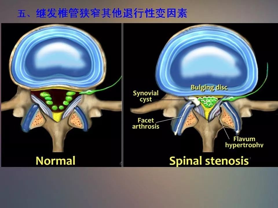 影像PPT - 【PPT】腰椎退行性变腰痛的MR诊断-48