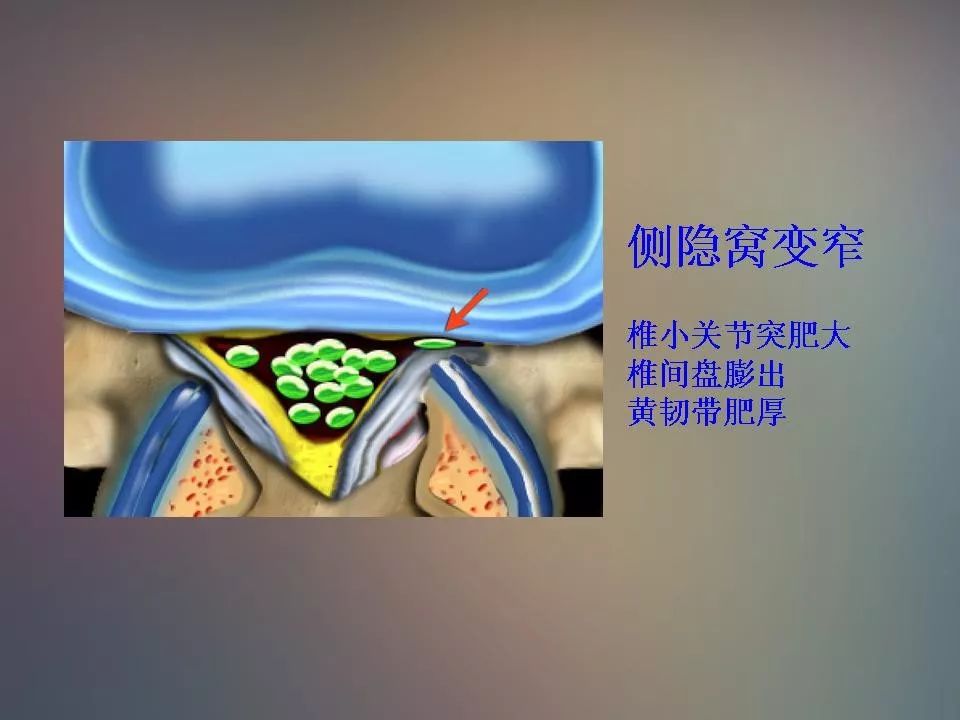 影像PPT - 【PPT】腰椎退行性变腰痛的MR诊断-49