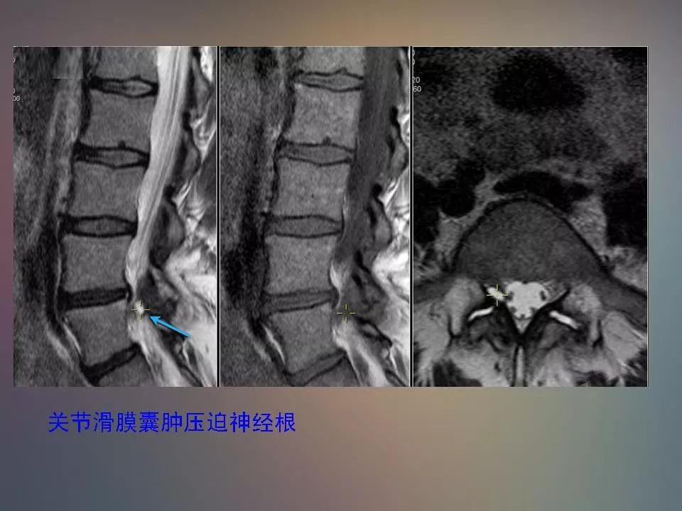 影像PPT - 【PPT】腰椎退行性变腰痛的MR诊断-51