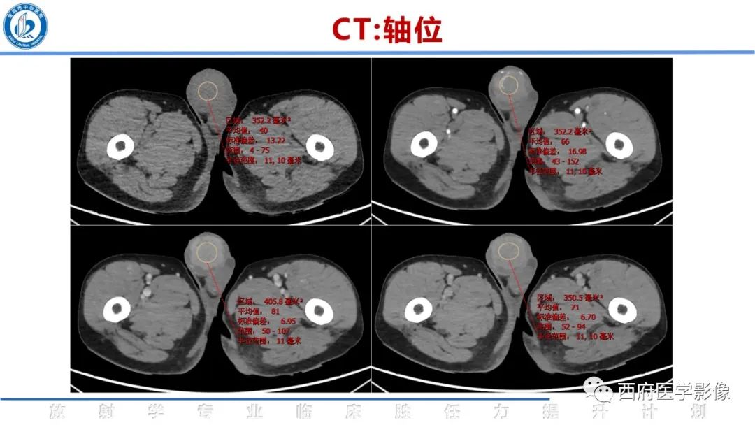 影像PPT - 【病例】睾丸浆细胞骨髓瘤1例CT及MR影像-4