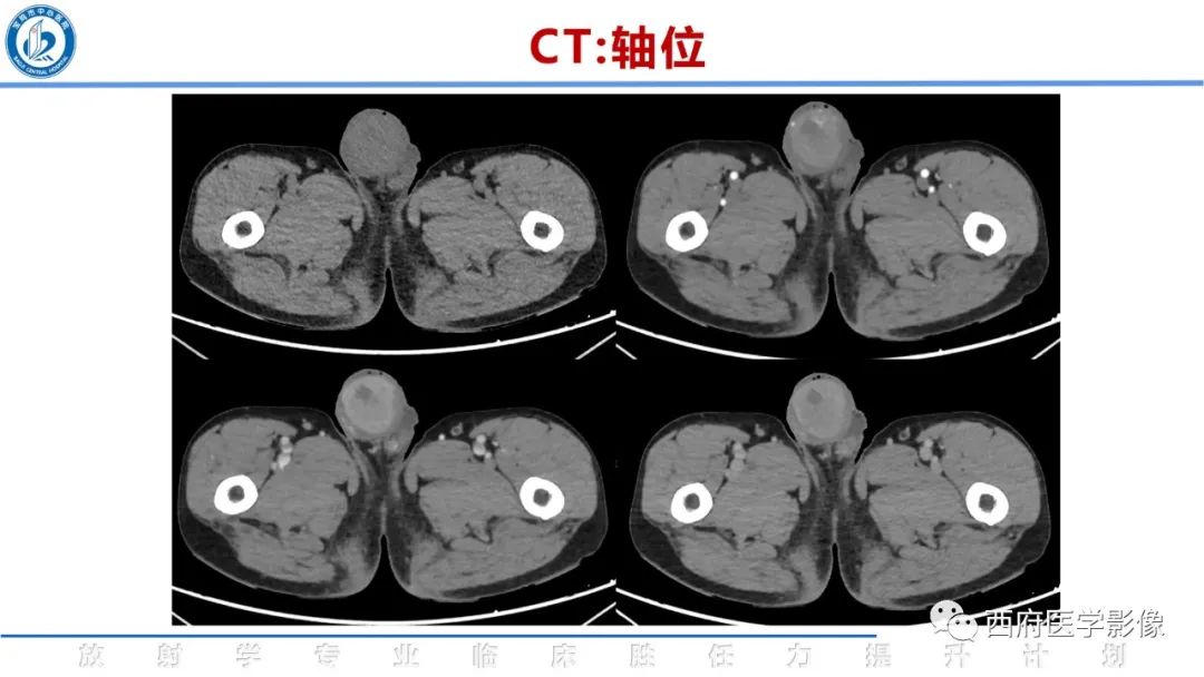 影像PPT - 【病例】睾丸浆细胞骨髓瘤1例CT及MR影像-5