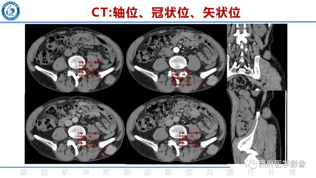 影像PPT - 【病例】睾丸浆细胞骨髓瘤1例CT及MR影像-7