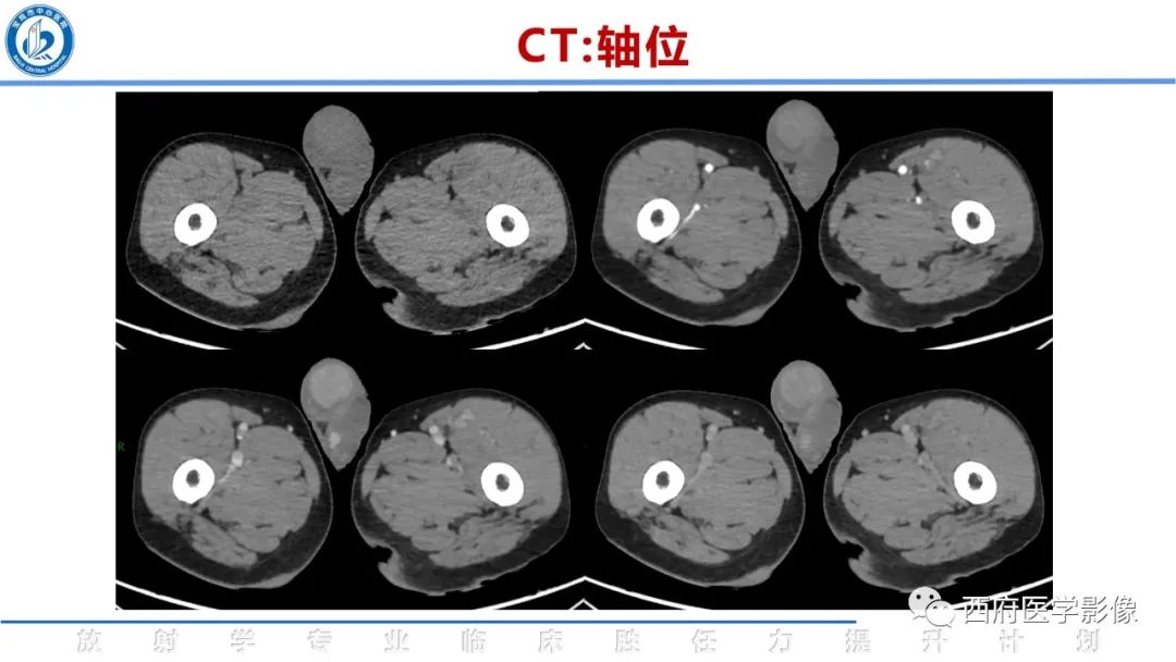 影像PPT - 【病例】睾丸浆细胞骨髓瘤1例CT及MR影像-6