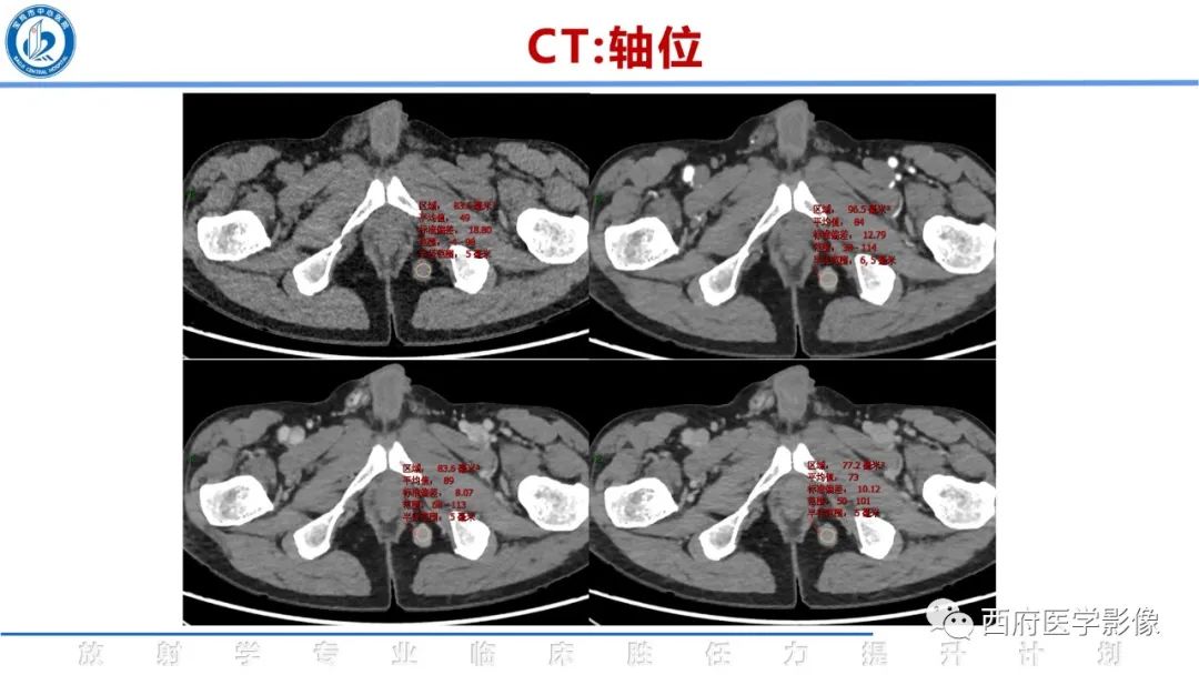 影像PPT - 【病例】睾丸浆细胞骨髓瘤1例CT及MR影像-9