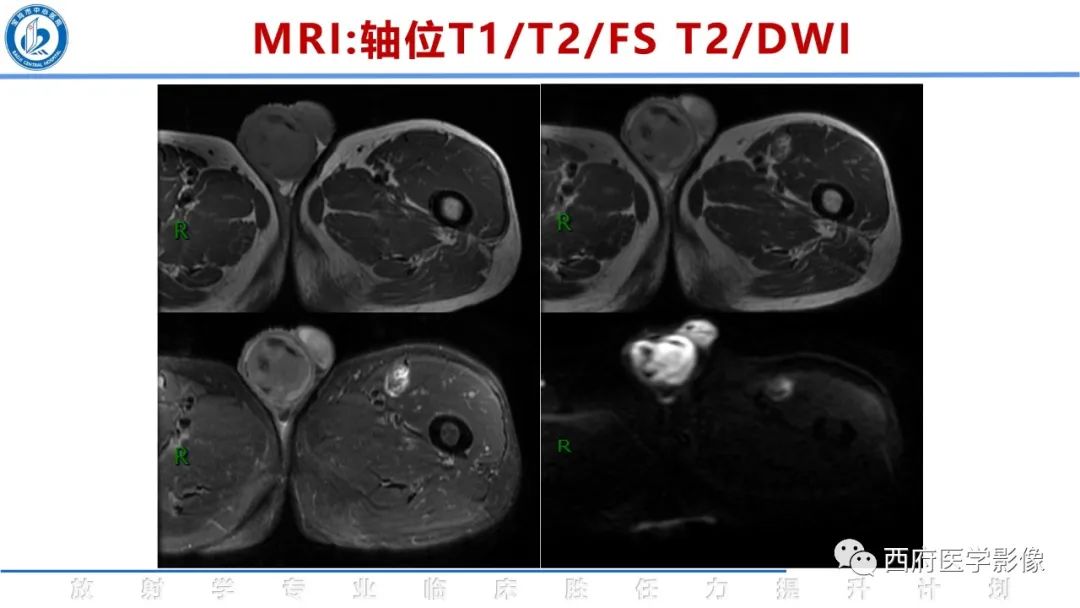 影像PPT - 【病例】睾丸浆细胞骨髓瘤1例CT及MR影像-12