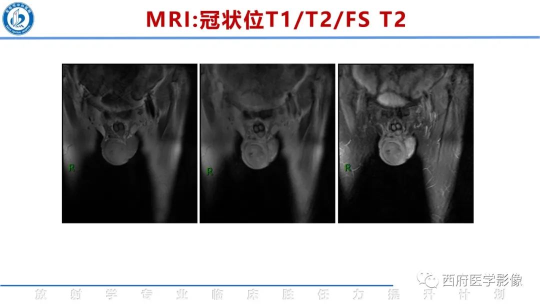 影像PPT - 【病例】睾丸浆细胞骨髓瘤1例CT及MR影像-13