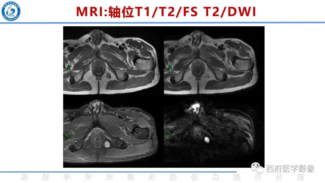 影像PPT - 【病例】睾丸浆细胞骨髓瘤1例CT及MR影像-14