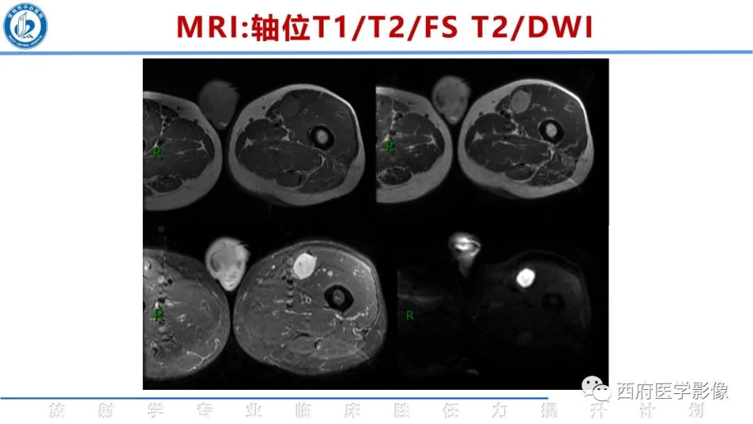 影像PPT - 【病例】睾丸浆细胞骨髓瘤1例CT及MR影像-15
