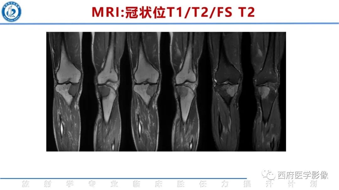 影像PPT - 【病例】睾丸浆细胞骨髓瘤1例CT及MR影像-16