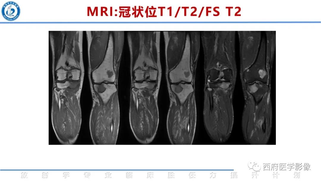 影像PPT - 【病例】睾丸浆细胞骨髓瘤1例CT及MR影像-17