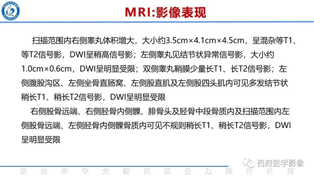 影像PPT - 【病例】睾丸浆细胞骨髓瘤1例CT及MR影像-18