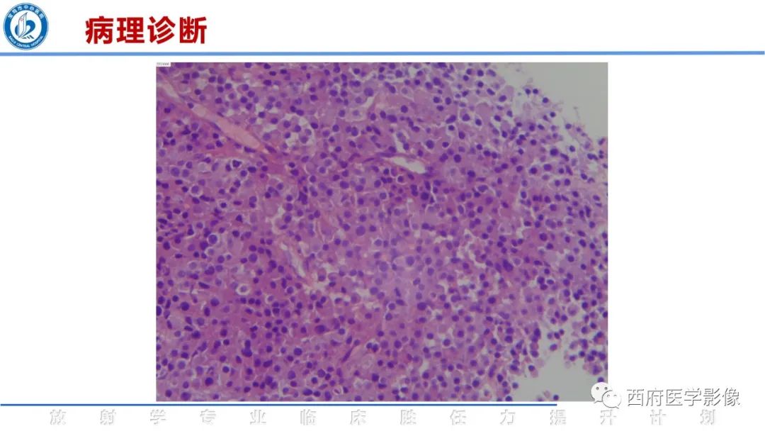 影像PPT - 【病例】睾丸浆细胞骨髓瘤1例CT及MR影像-23