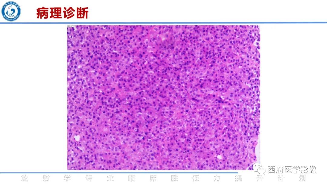 影像PPT - 【病例】睾丸浆细胞骨髓瘤1例CT及MR影像-25