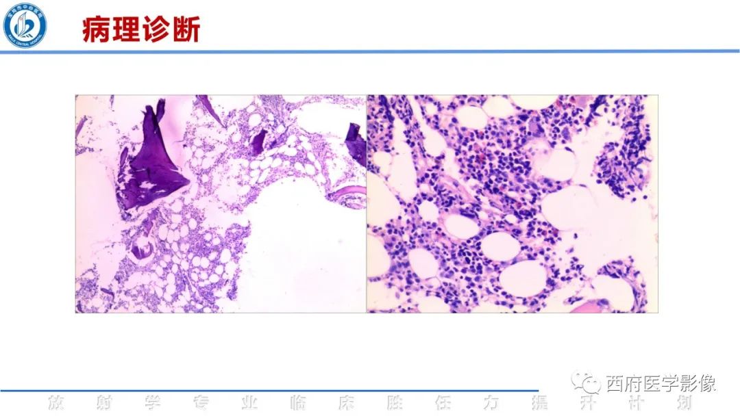 影像PPT - 【病例】睾丸浆细胞骨髓瘤1例CT及MR影像-27