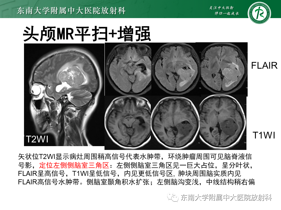 影像PPT - 【PPT】侧脑室脑膜瘤-4