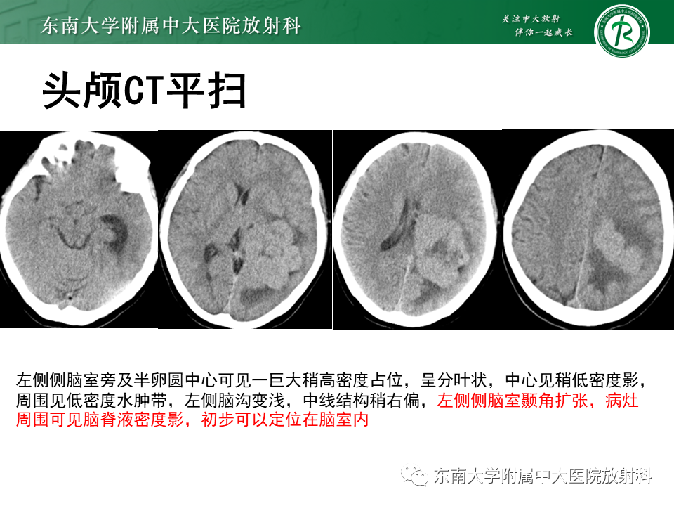 影像PPT - 【PPT】侧脑室脑膜瘤-3