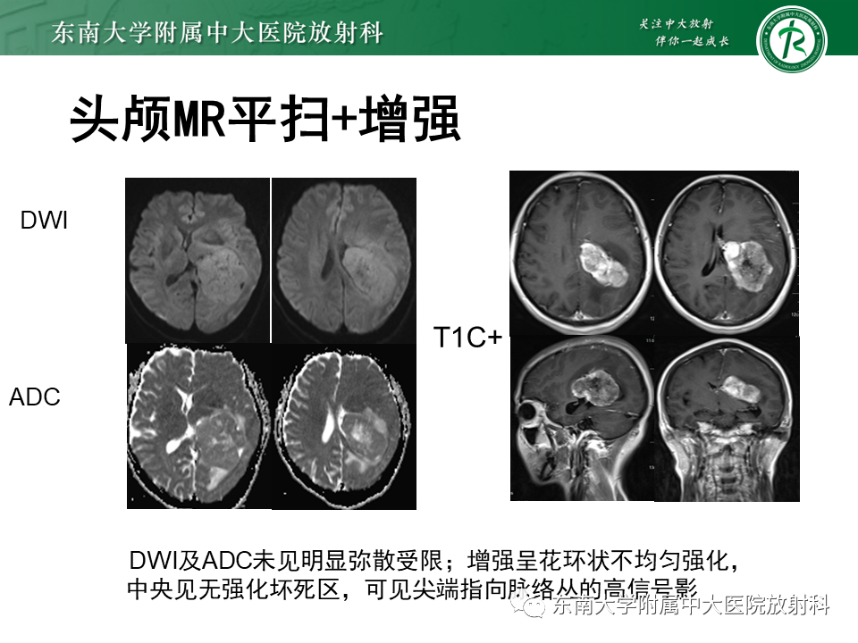 影像PPT - 【PPT】侧脑室脑膜瘤-5