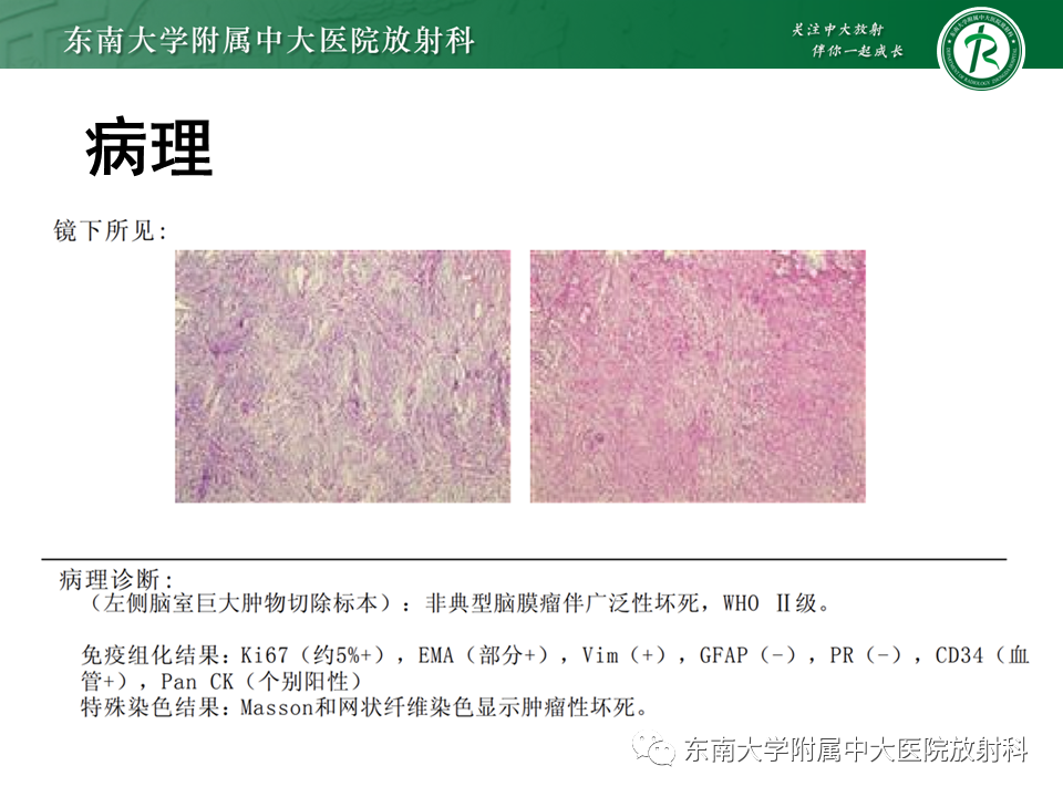 影像PPT - 【PPT】侧脑室脑膜瘤-6