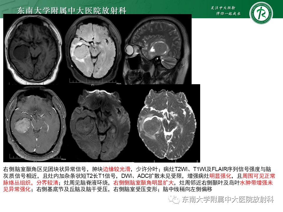 影像PPT - 【PPT】侧脑室脑膜瘤-15