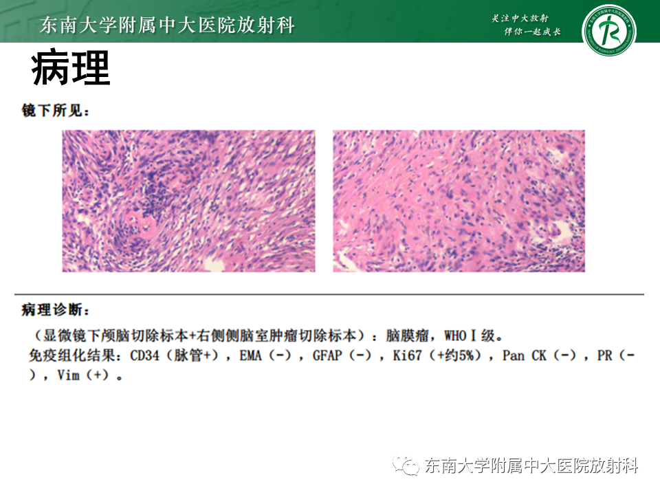 影像PPT - 【PPT】侧脑室脑膜瘤-16