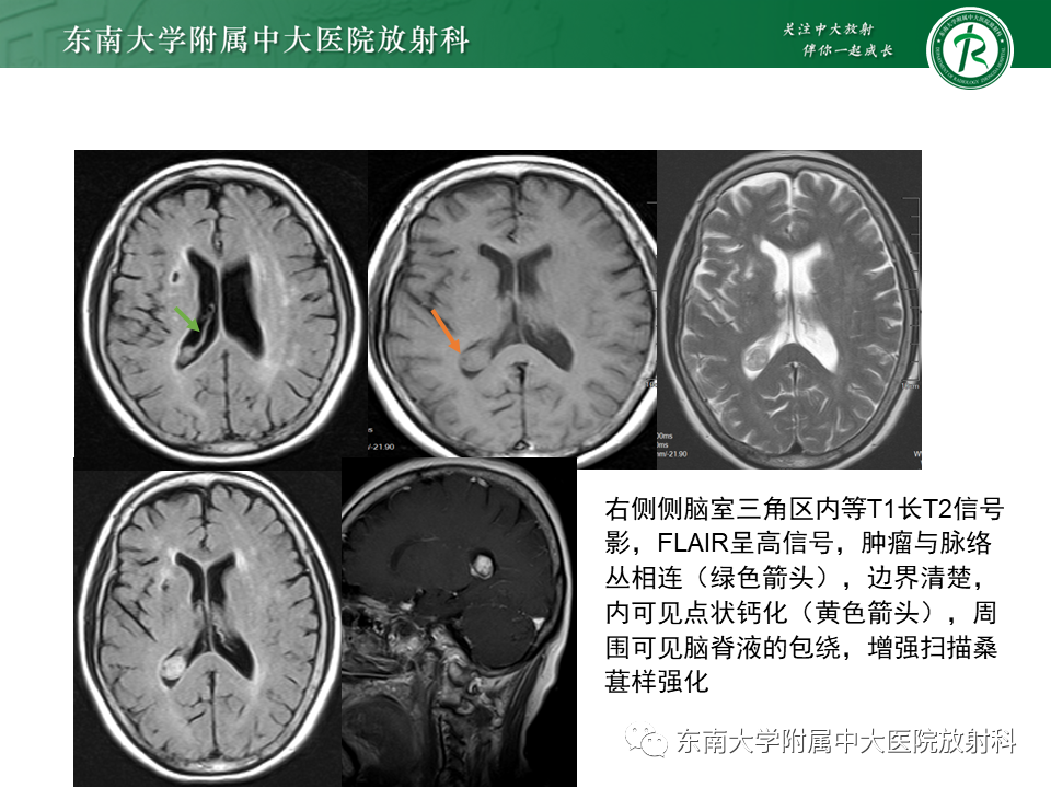 影像PPT - 【PPT】侧脑室脑膜瘤-23