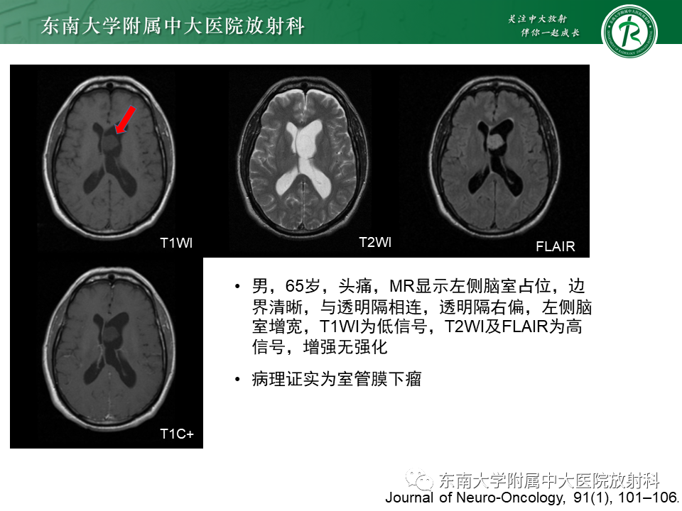 影像PPT - 【PPT】侧脑室脑膜瘤-30