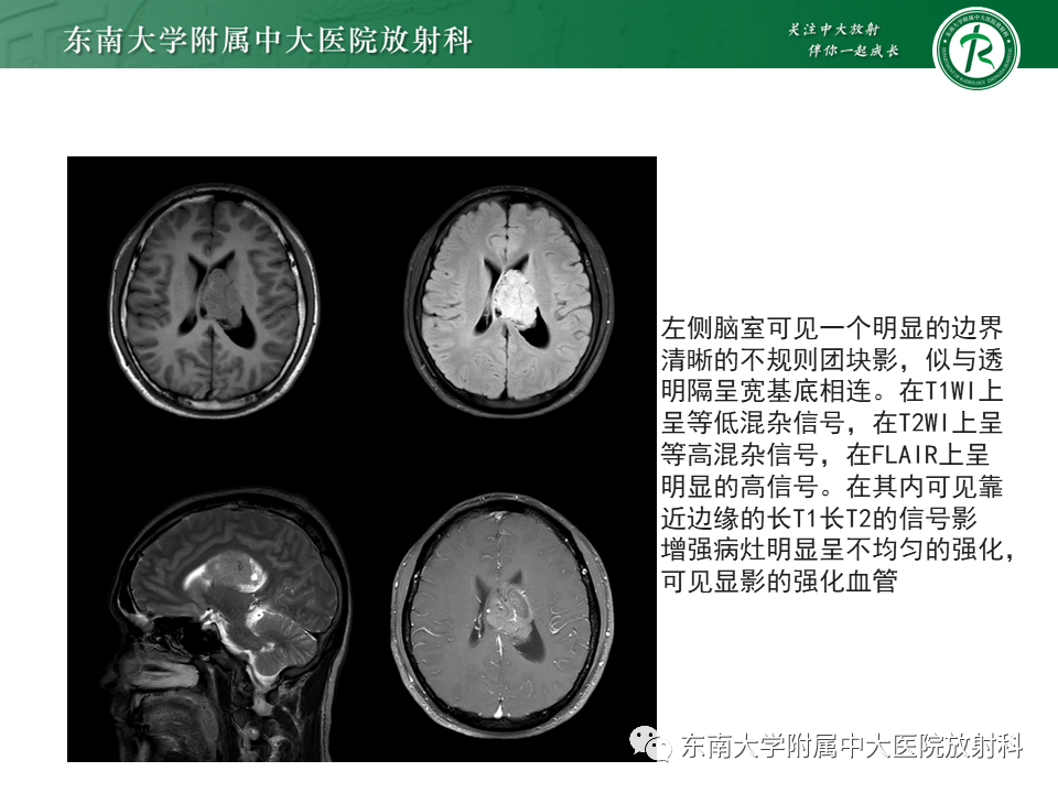 影像PPT - 【PPT】侧脑室脑膜瘤-34