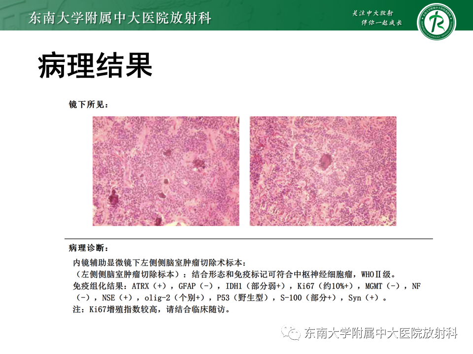 影像PPT - 【PPT】侧脑室脑膜瘤-35