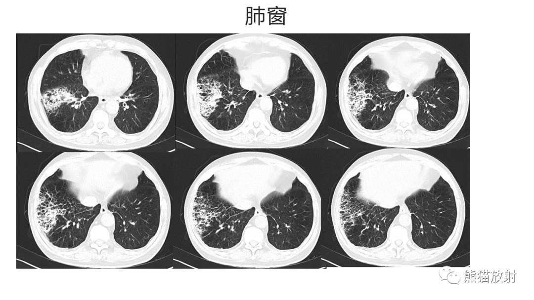 影像PPT - 【病例】肺炎型肺癌 VS 肺组织慢性炎-4