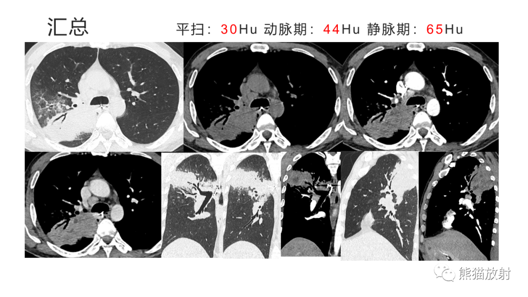 影像PPT - 【病例】肺炎型肺癌 VS 肺组织慢性炎-8