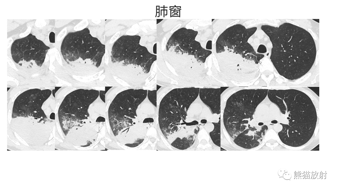 影像PPT - 【病例】肺炎型肺癌 VS 肺组织慢性炎-9