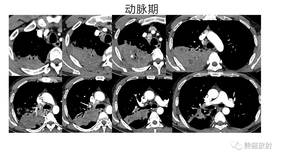 影像PPT - 【病例】肺炎型肺癌 VS 肺组织慢性炎-10