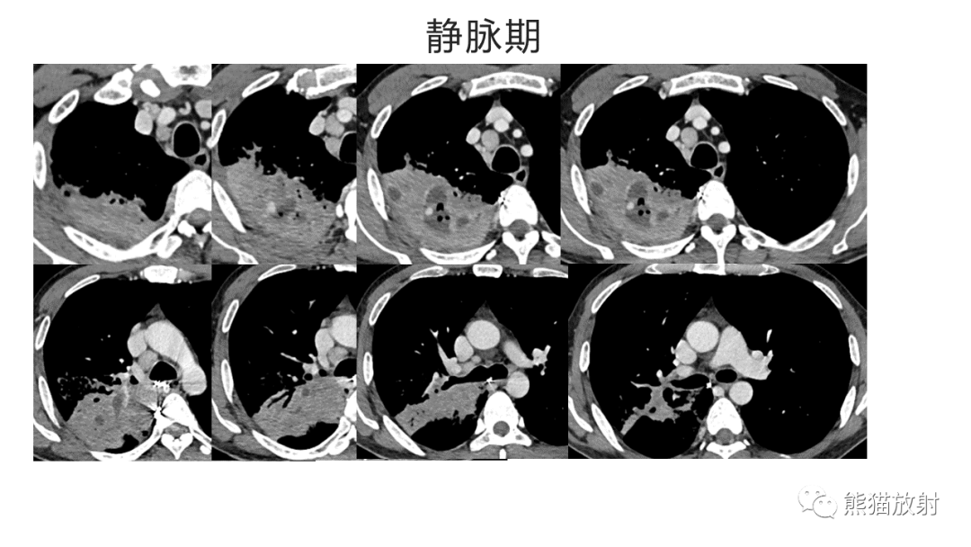 影像PPT - 【病例】肺炎型肺癌 VS 肺组织慢性炎-11