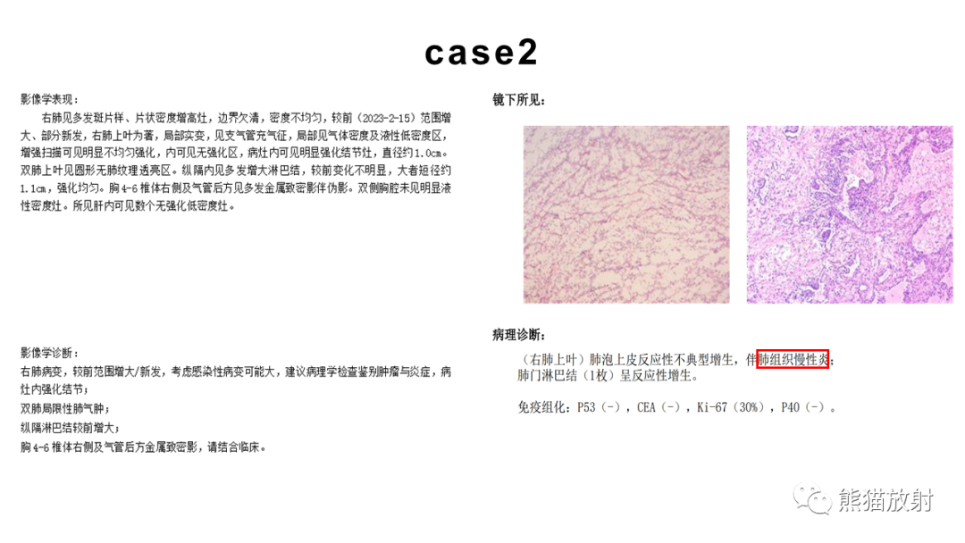 影像PPT - 【病例】肺炎型肺癌 VS 肺组织慢性炎-13